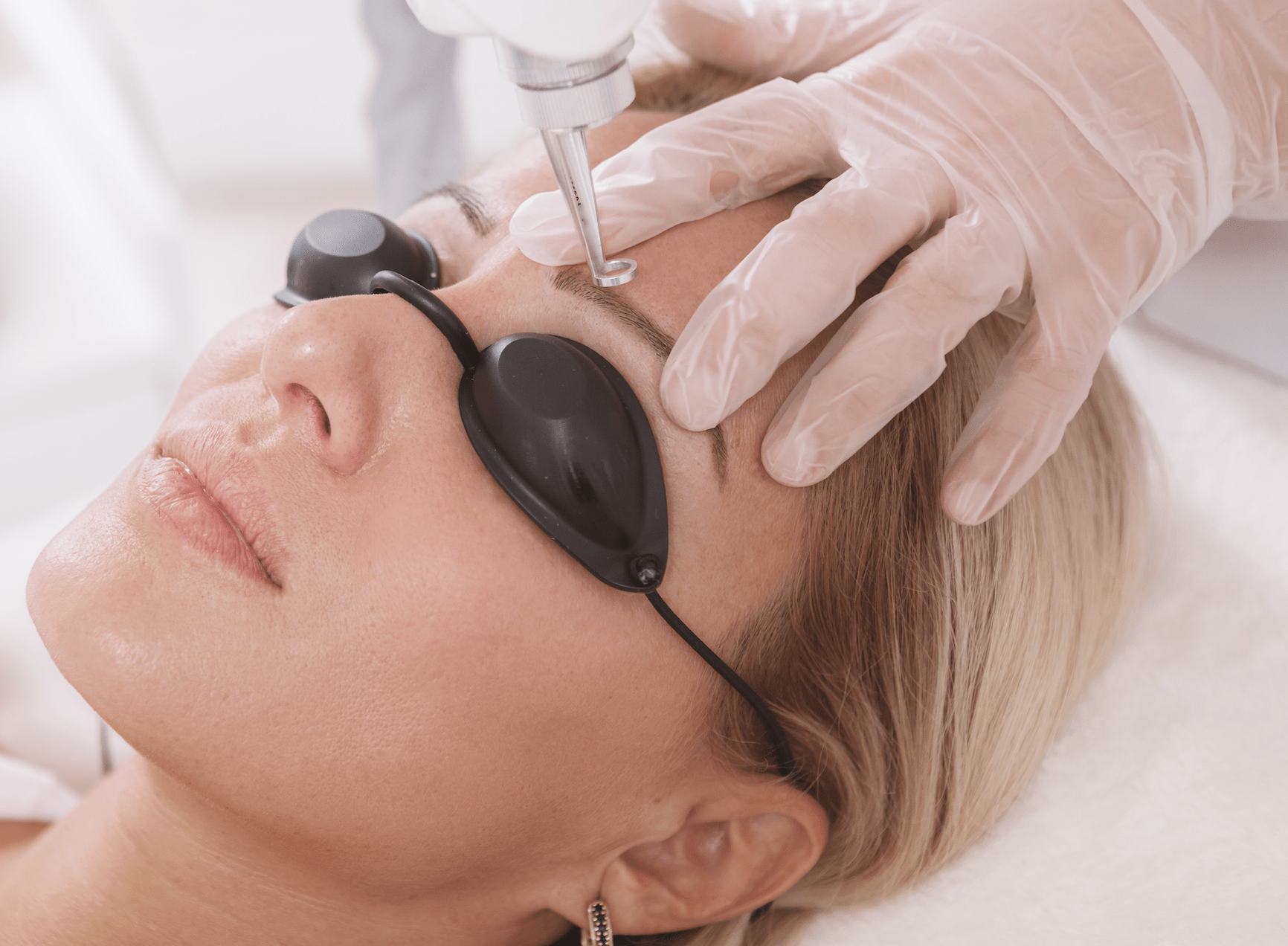 tattooed eyebrows removed with laser. laser semi permanent eyebrow removal