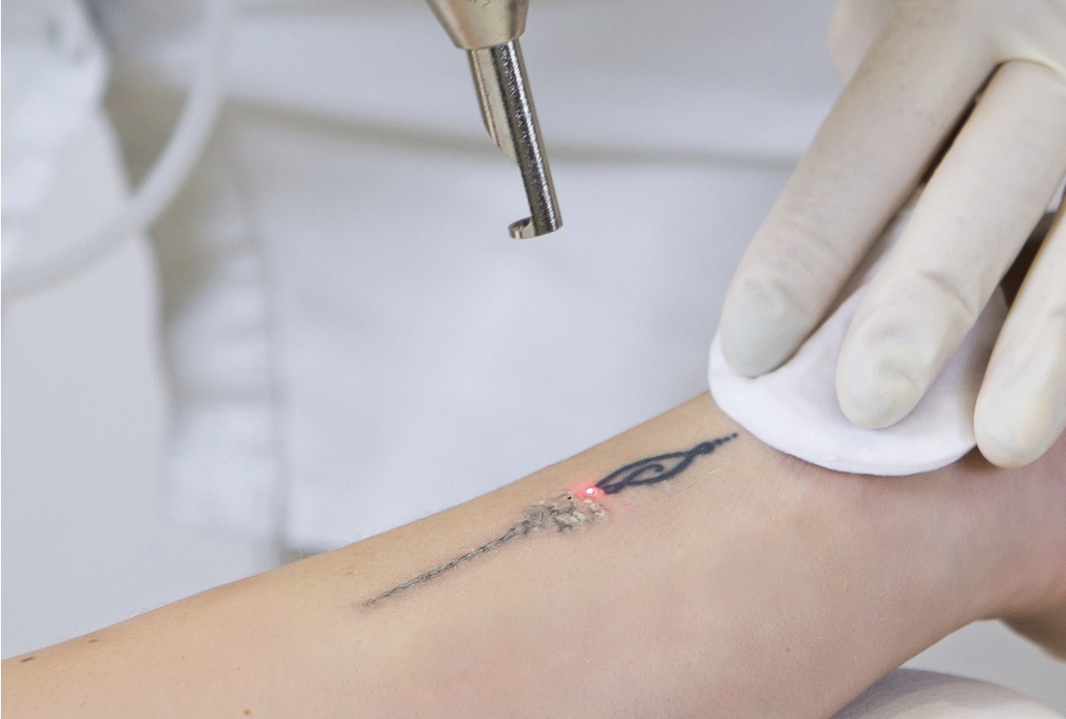 Laser Tattoo Removal Cheshire Laser Tattoo Removal Cheshire