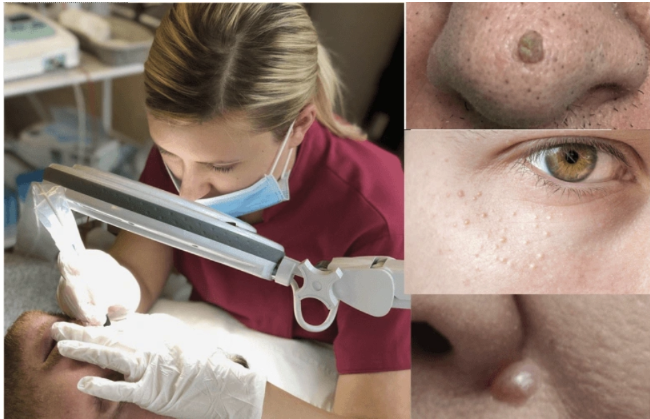 Skin Blemish Removal Cheshire Skin Blemish Removal Cheshire