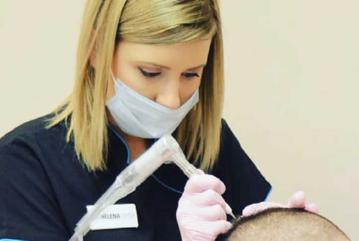 Scalp Micropigmentation Tattooing Cheshire Scalp Micropigmentation Tattooing Cheshire